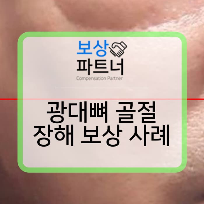 광대뼈, 얼굴뼈 s02490 함몰 산재 장해등급 판정과 일반 생손보사 보상 사례