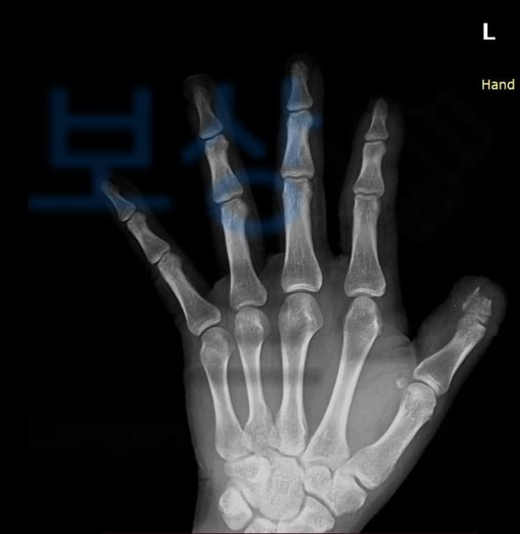 산재보상금 얼마? 손가락의 산재장해약관 소개해드립니다~