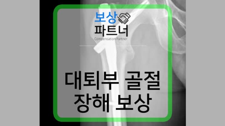 대퇴부 골절 금속 내고정술 시행했다면 장해 보상도 미리 알아보세요.