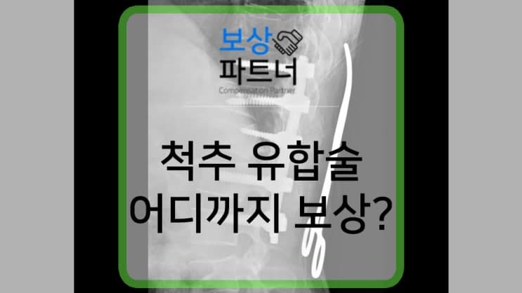 흉추, 요추 후방 유합술 (고정술) 산재 장애등급 7급 손해보험1,000만원 보상 사례