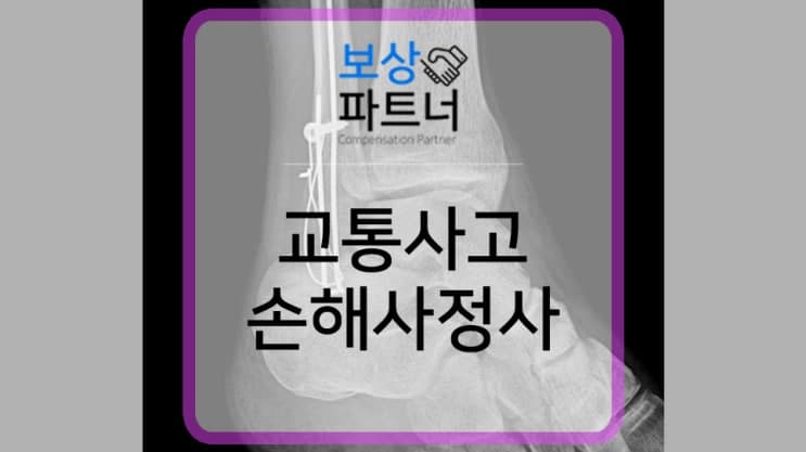 교통사고 독립 손해사정사, 발목골절수술 보상 이끌었습니다.