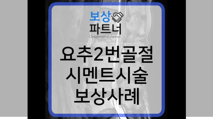 요추2번골절, 척추 시멘트시술 후유장애보험금 보상 사례