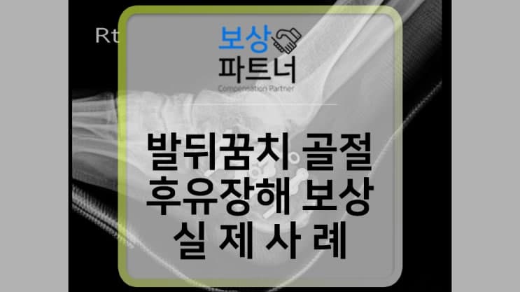 발뒤꿈치 골절 수술, 후유장해 보험금 보상 받았어요! (실제사례)