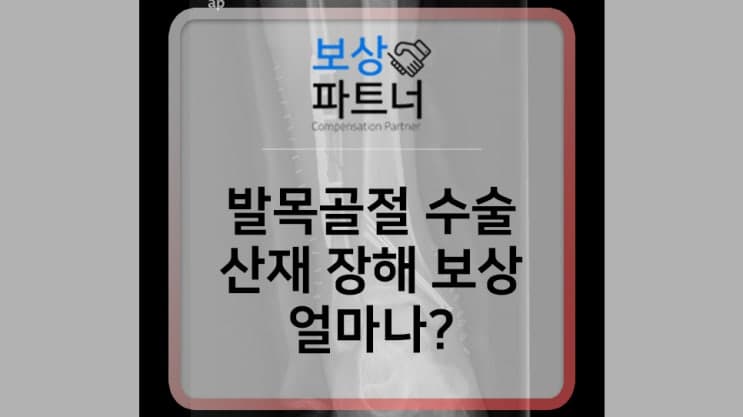 발목 이복사 골절 수술, 산재 장해등급과 보상금은 얼마?