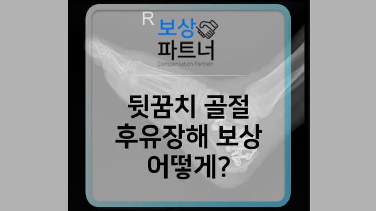 뒷꿈치 골절 수술 후 예전같지 않은 움직임. 후유장해 보험금 보상 가능하다?