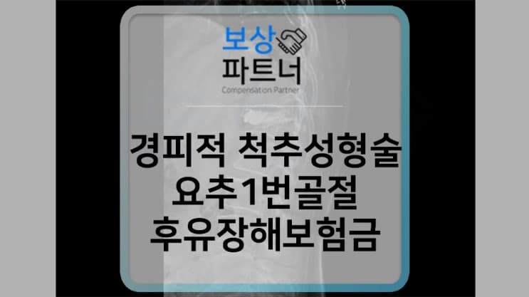 경피적 척추성형술(시멘트술) 요추1번골절 장해보험금