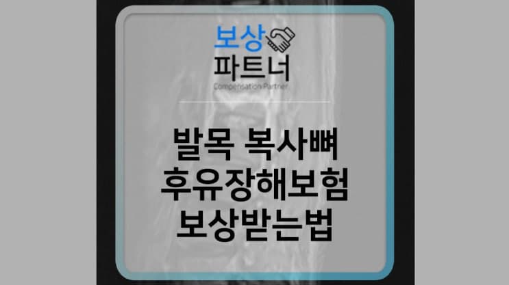 운동 중 발목 복사뼈 골절 후유장해보험금 보상받는 방법