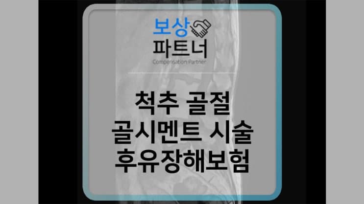 허리 골절(S32.0) 골시멘트술 받으셨다면? 후유장해보험 보상받으세요!