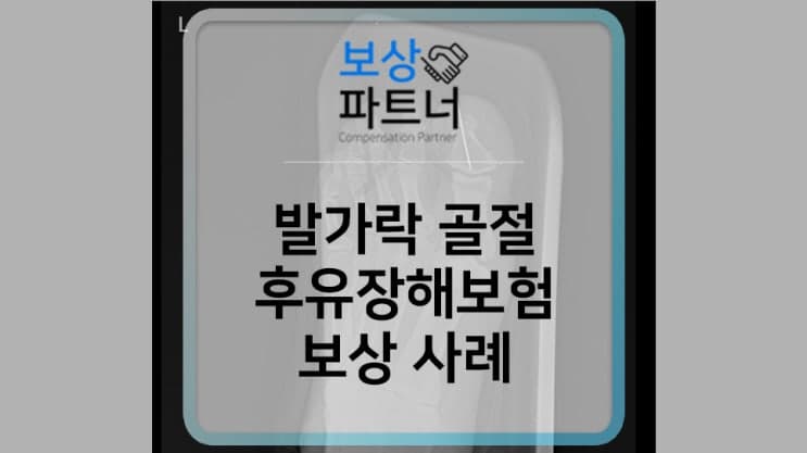 엄지발가락 골절되었다면 - 후유장해 보험금 청구 방법