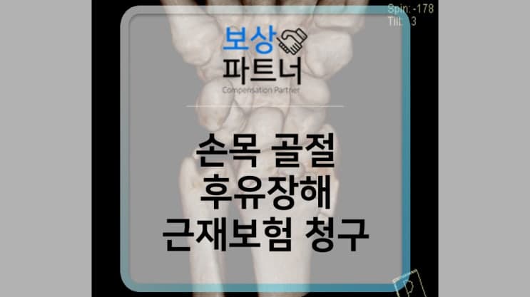 손목 골절(s5260) 후유장해 근재보험 청구 방법은?