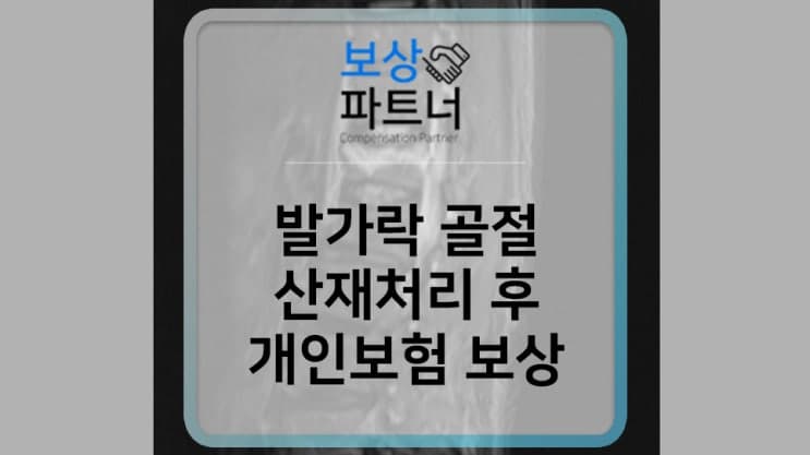 발가락 골절 수술 - 산재처리 후 개인보험 보상 사례
