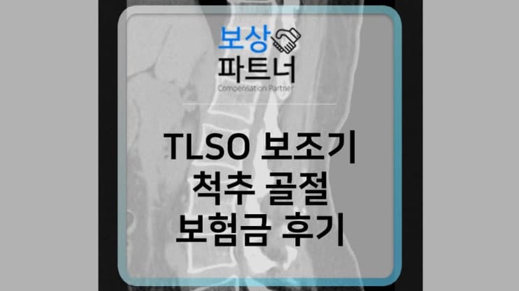 TLSO 허리보조기 사용 후 척추골절 보험금 받은 후기