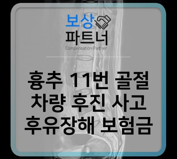 차량 후진사고로 척추압박골절(흉추11번) 후유장해 보상 사례